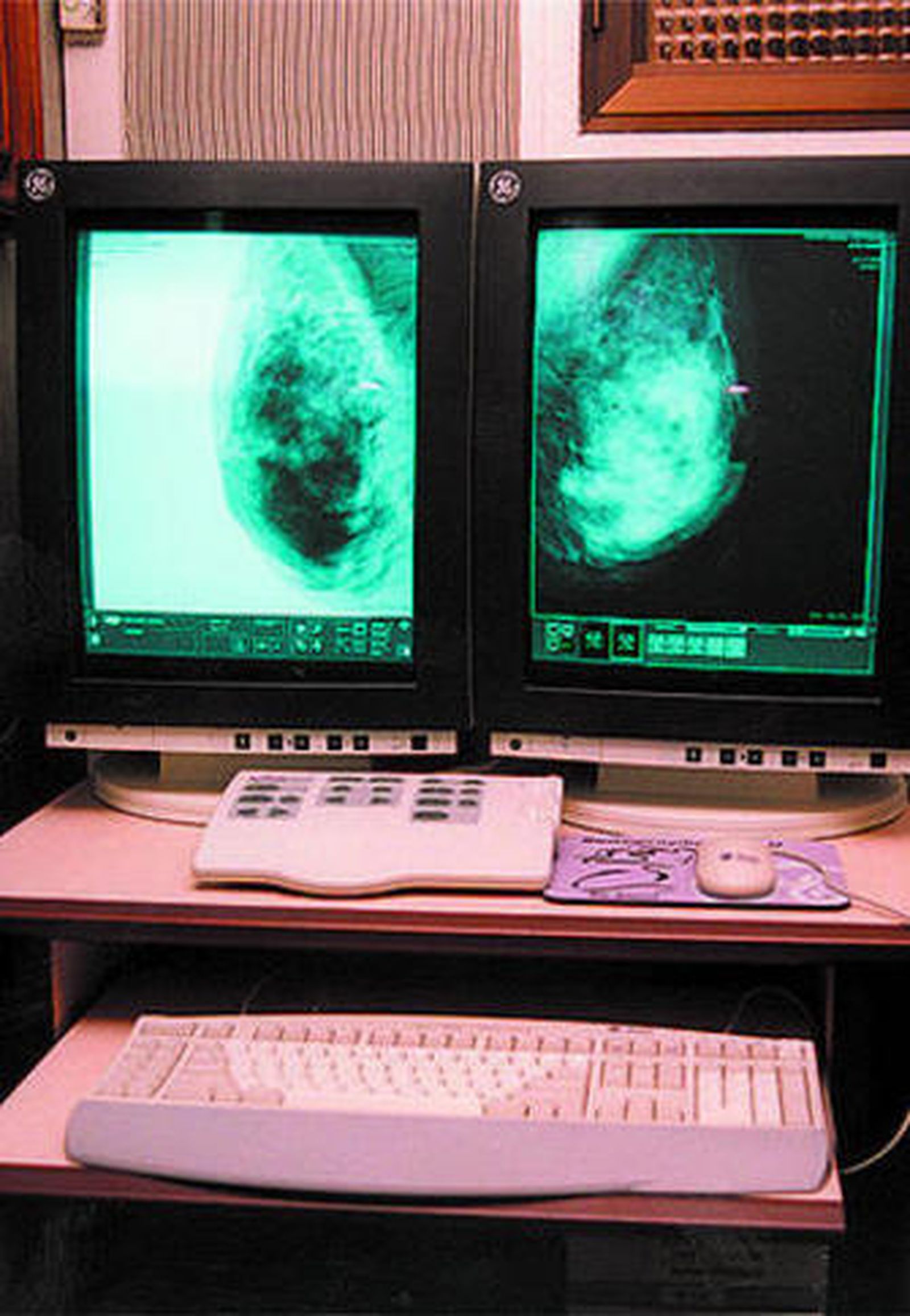 Una mamografía digital.