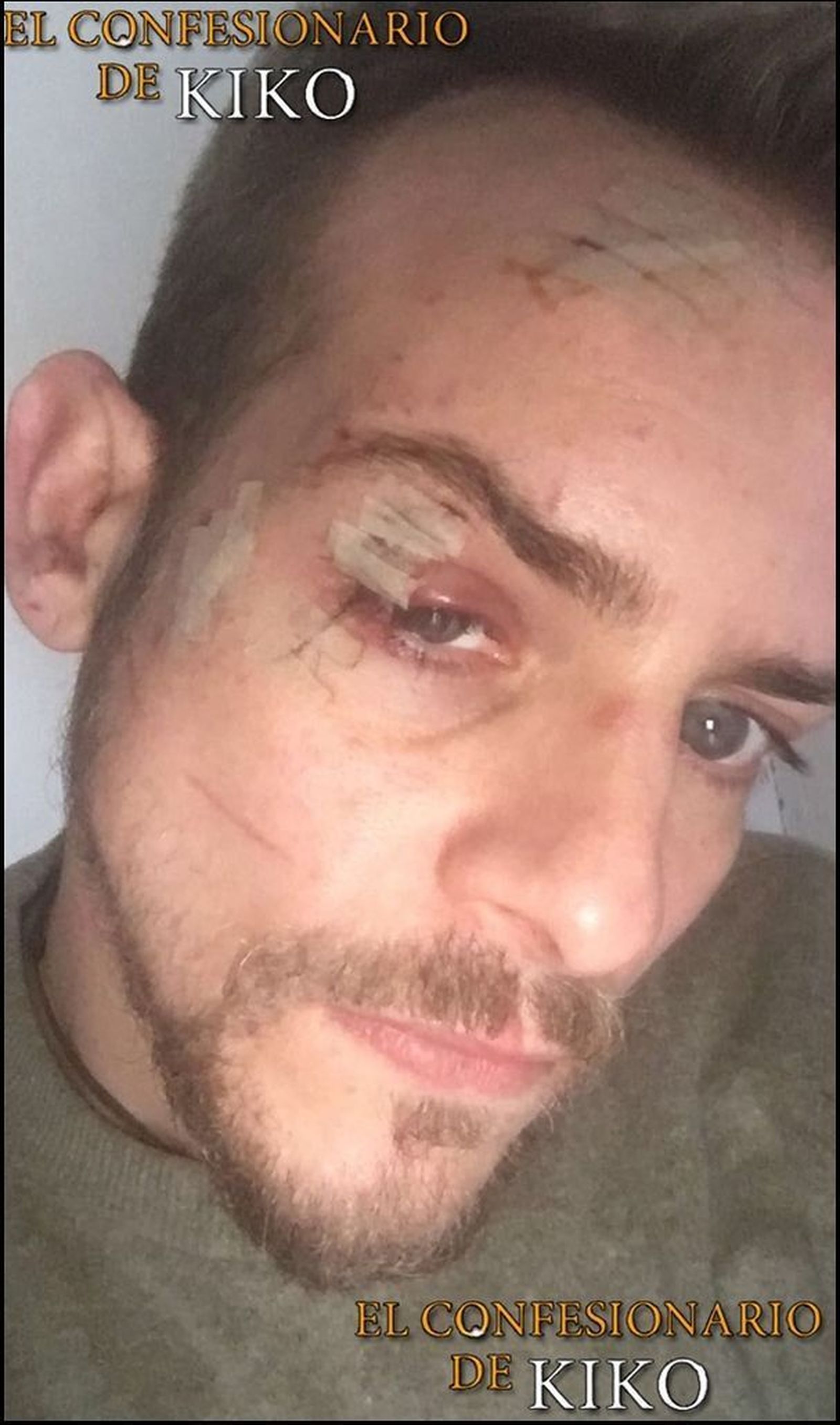 Casademunt, víctima de una brutal agresión