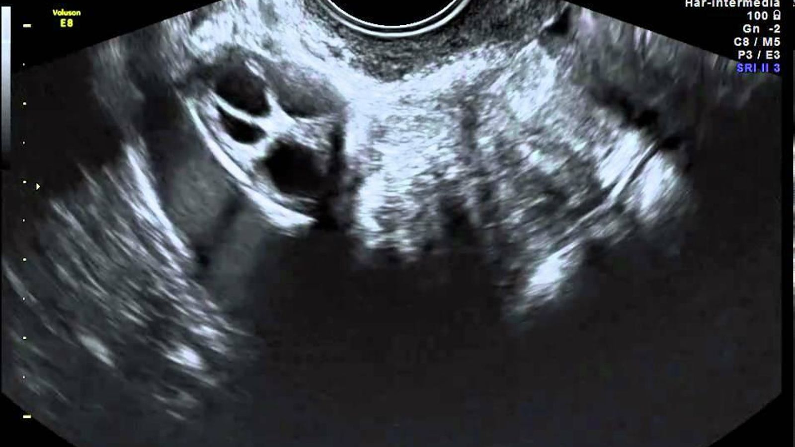 Monitoreo de ultrasonido