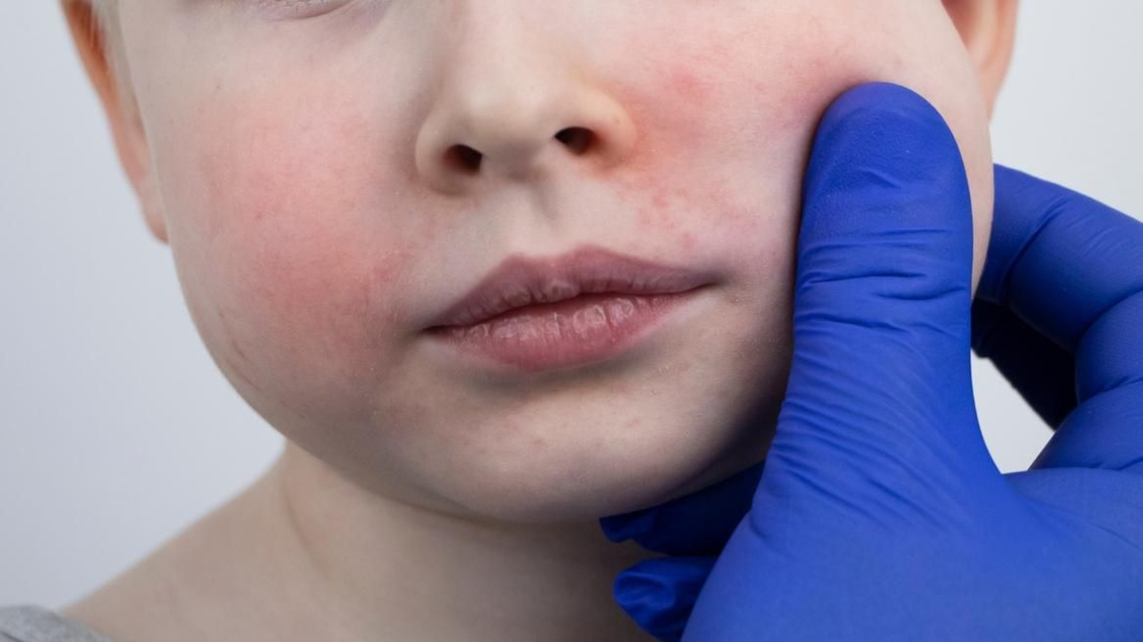 Este virus se detecta con una rojez en los mofletes, y afecta mayormente a niños