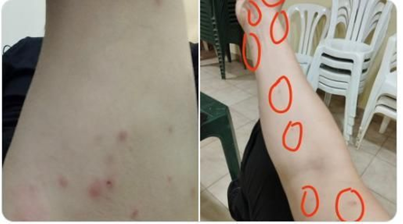 Imagen difundida en Twitter por un usuario donde se pueden apreciar numerosas picaduras de mosquitos.