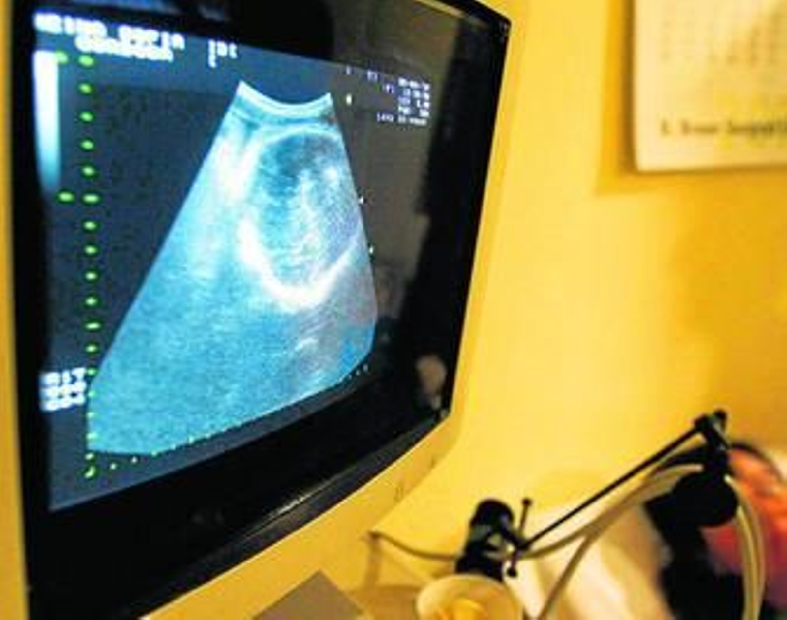 Una paciente, durante una revisión se somete a una ecografía.