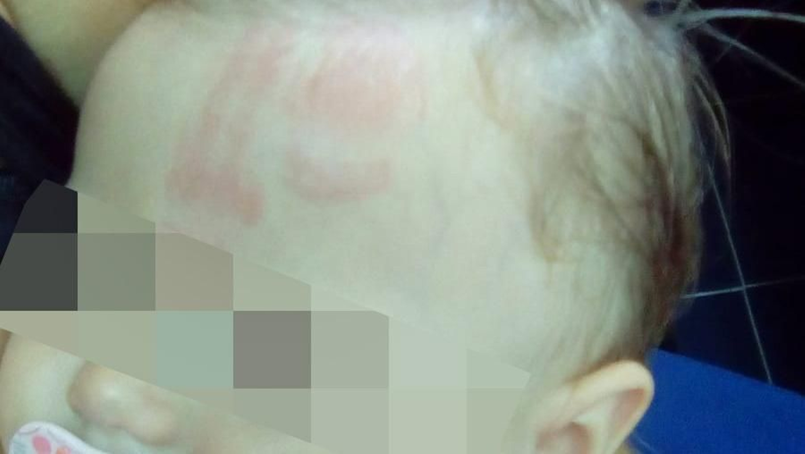 Marcas que presentaba la pequeña en la cabeza cuando fue recogida del centro, según denunció su madre.
