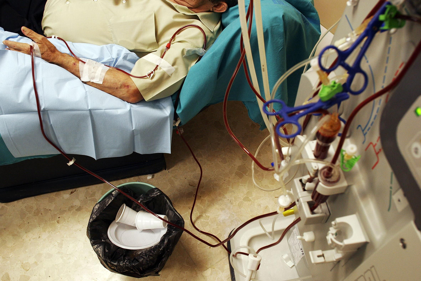 Un paciente en diálisis.