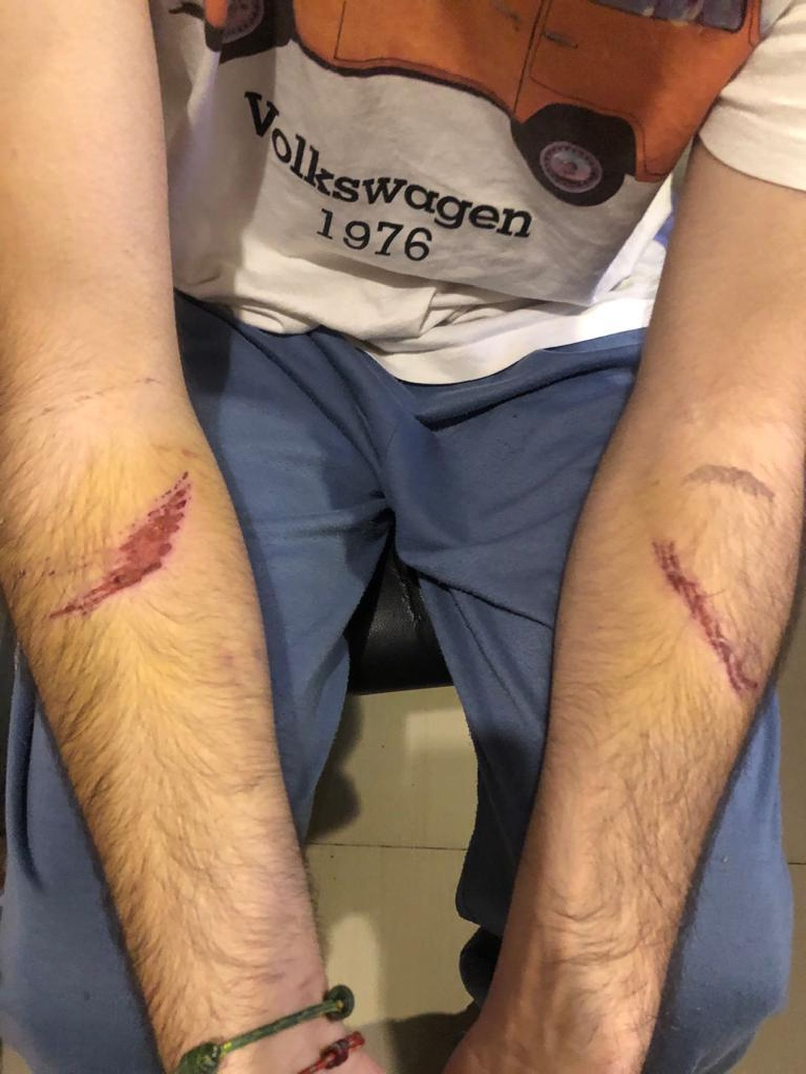 Las heridas del ciclista magullado tras el accidente