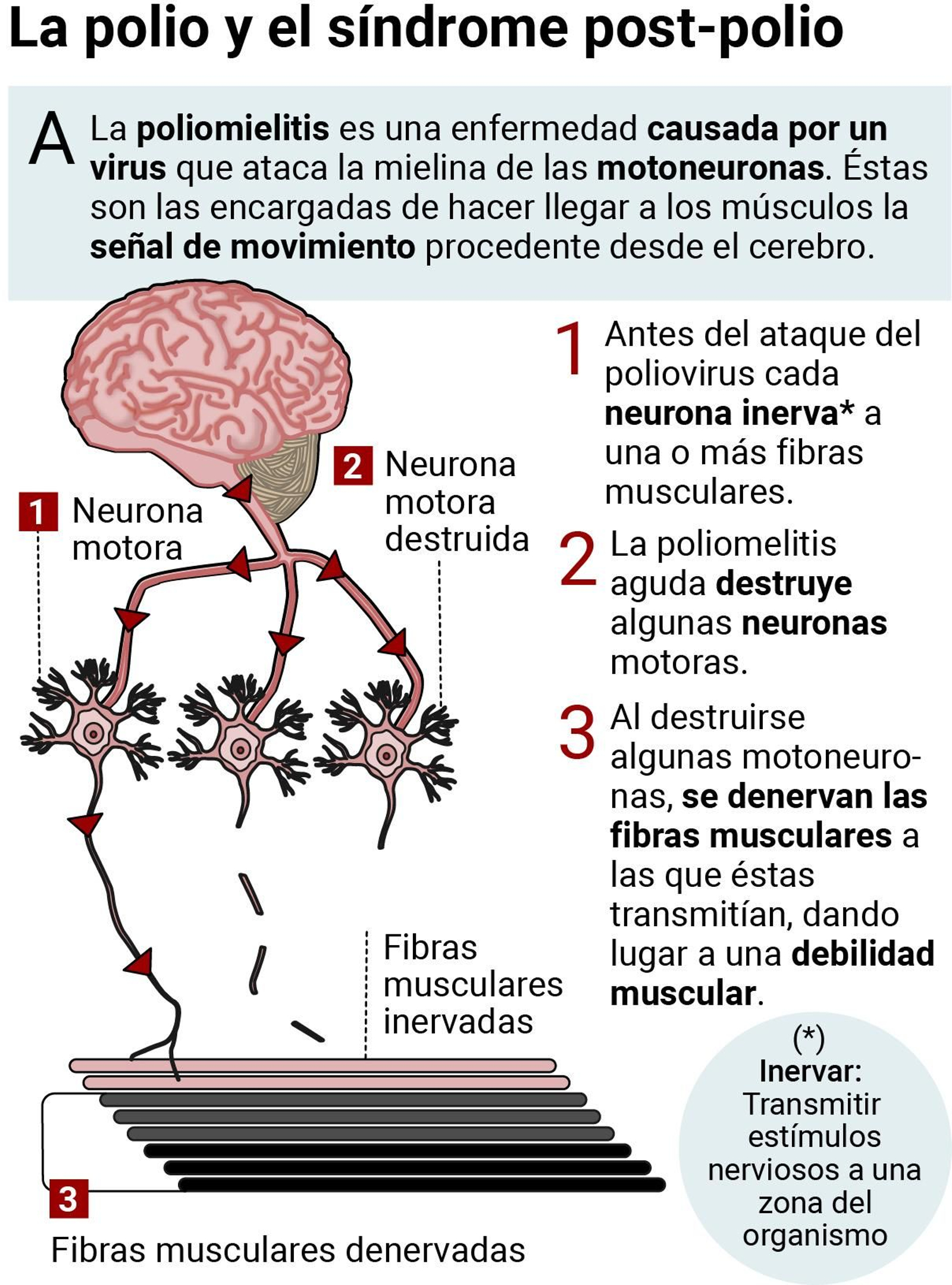La polio y el síndrome post-polio