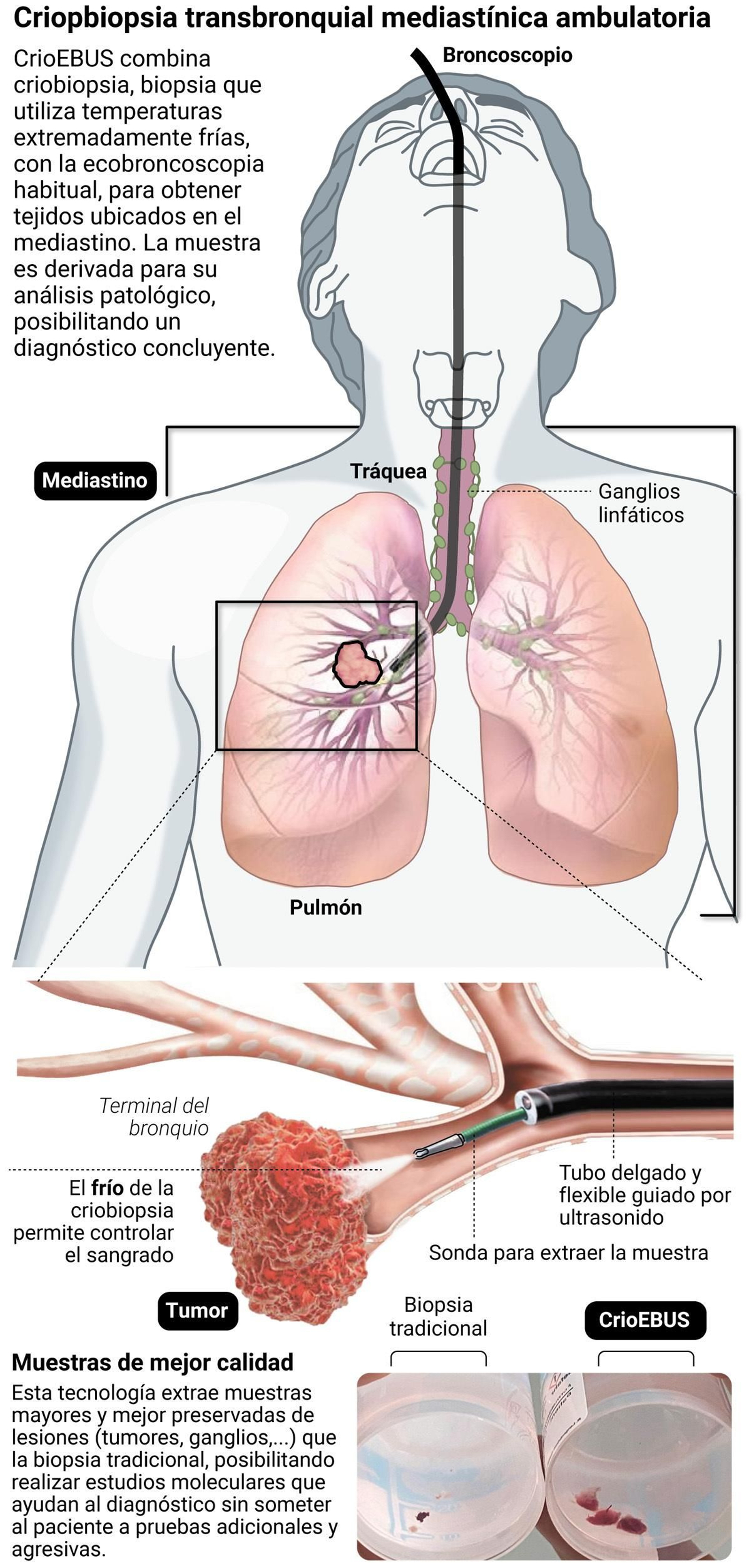 Infografía que explica la tecnología CrioEBUS. Fuente: Hospital de Valme.