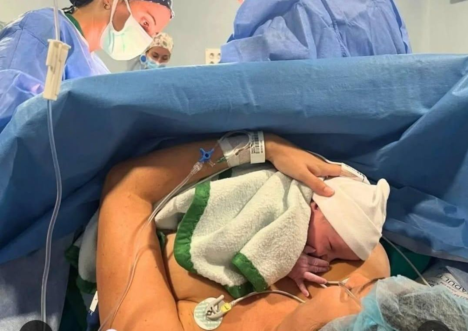 Un recién nacido y su madre en la aplicación del programa piel con piel en partos por cesárea dentro del quirófano.