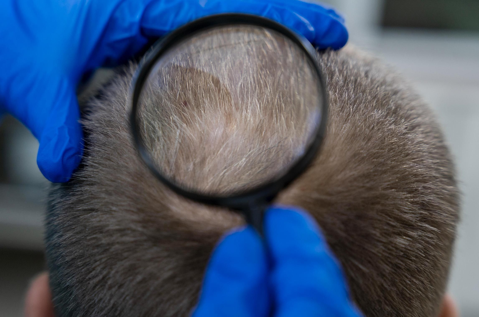 Vacuna contra la alopecia: qué es y cuándo estaría disponible