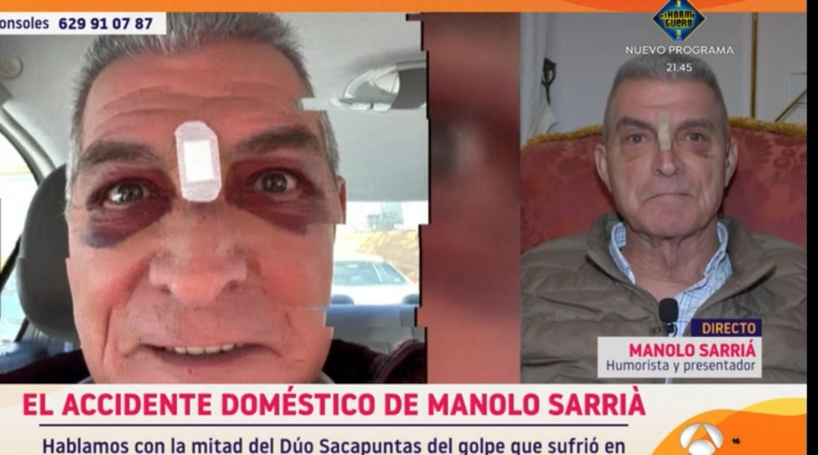 La aparatosa herida de Manolo Sarria, compartida en redes, y a la derecha, en su entrevista de este martes en Antena 3