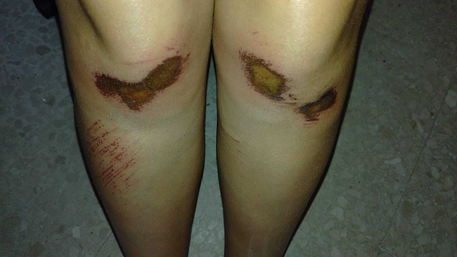 Así quedaron las piernas de una de las víctimas.