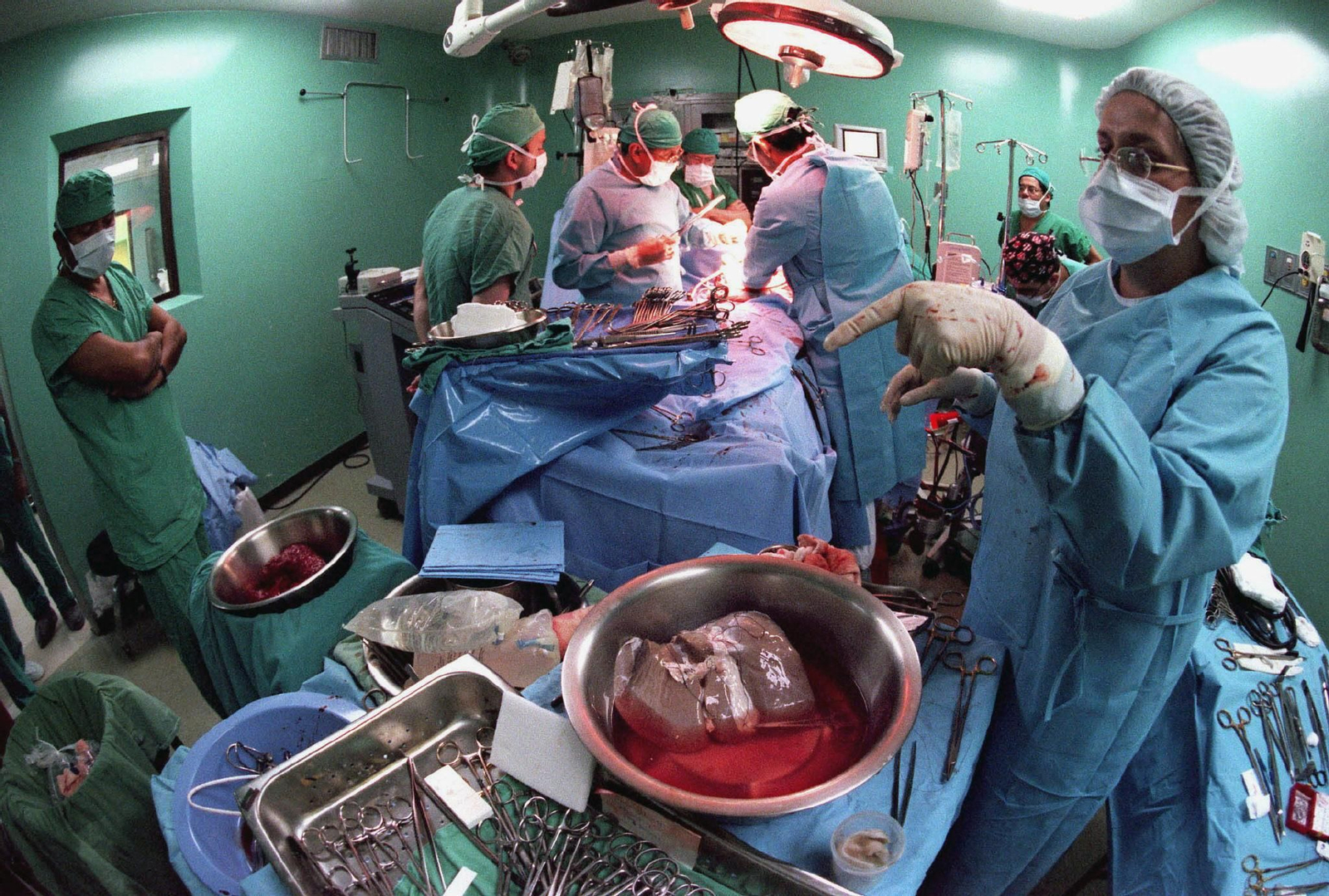 Profesionales médicos durante un trasplante de hígado.