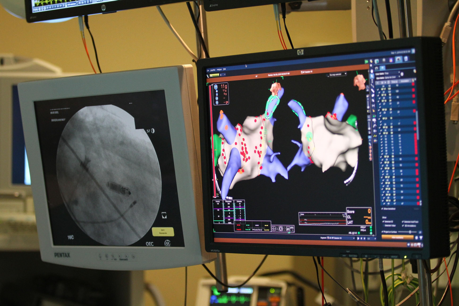 El Hospital Juan Ramón Jiménez implanta los dos primeros marcapasos sin cable en pacientes onubenses