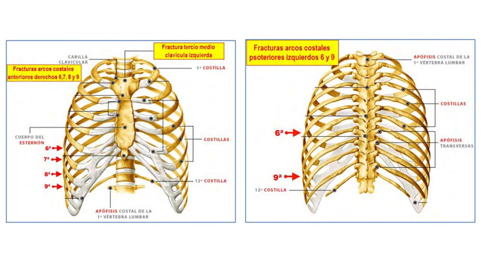Indicaciones de las fracturas costales de Alicia Rodríguez.