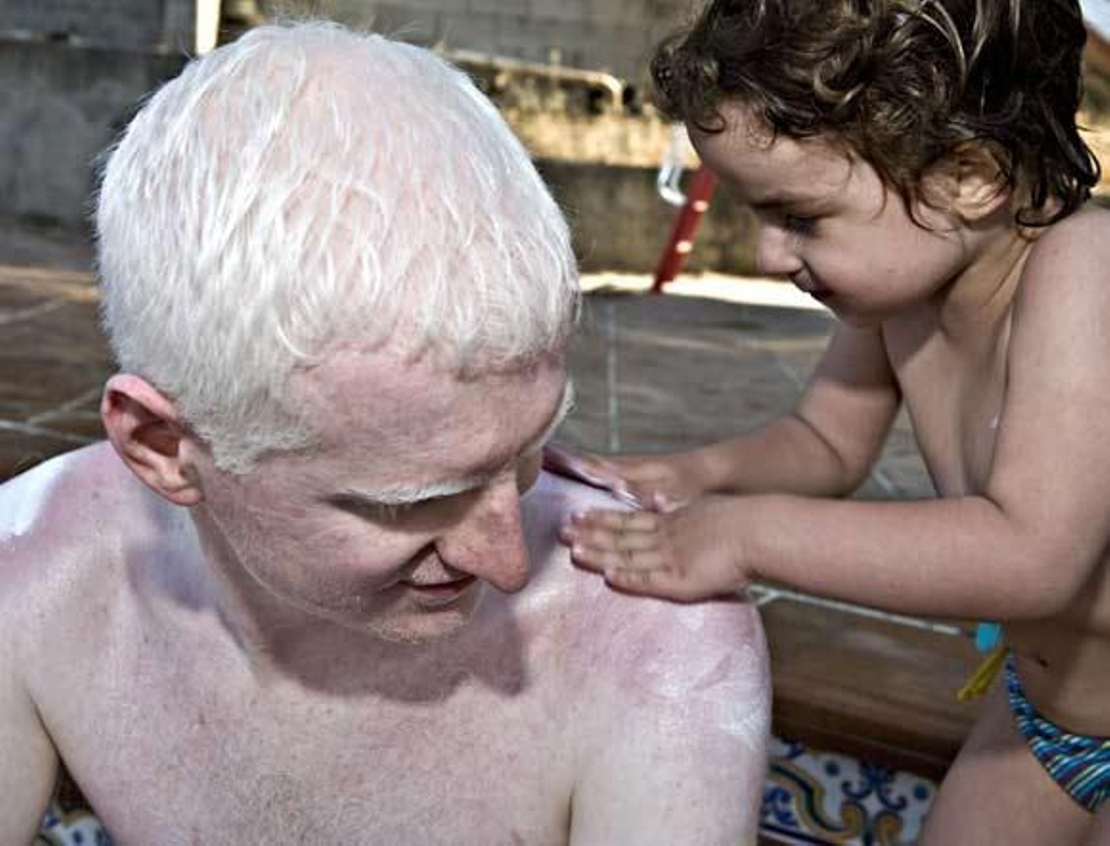 La autoaceptación, un gran paso para la integración del albino