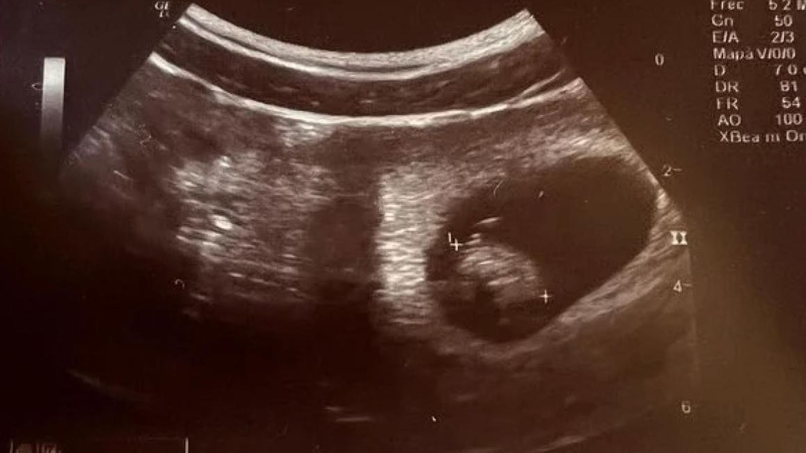 Radiografía del primer hijo de Miguel Herrán