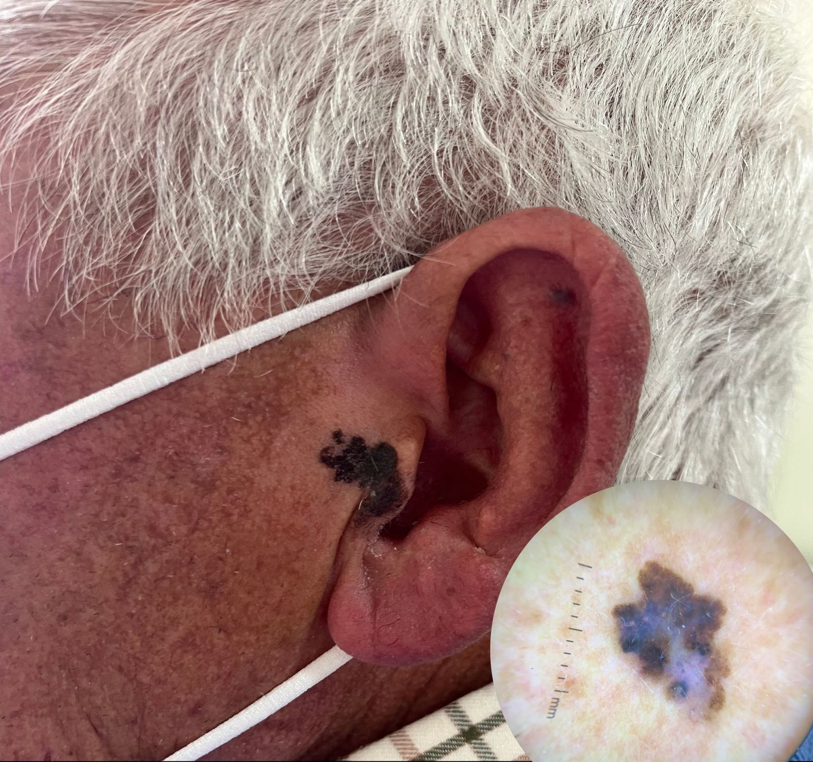 Imagen de una lesión de melanoma en anciano.