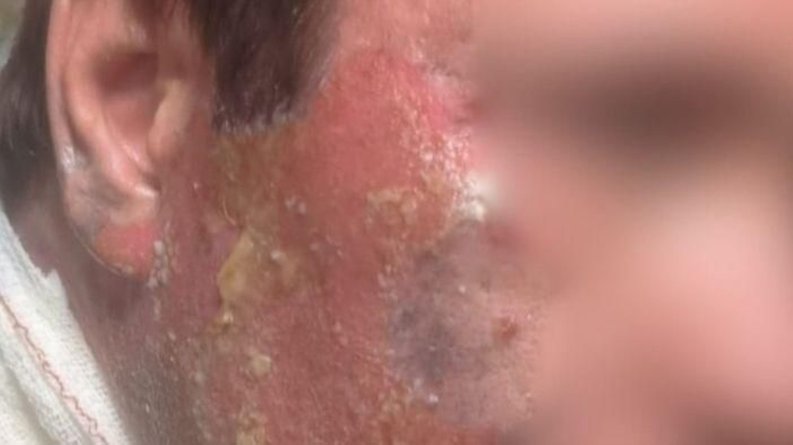 Las quemaduras que sufrió el joven en el rostro Las quemaduras que sufrió el joven en el rostro