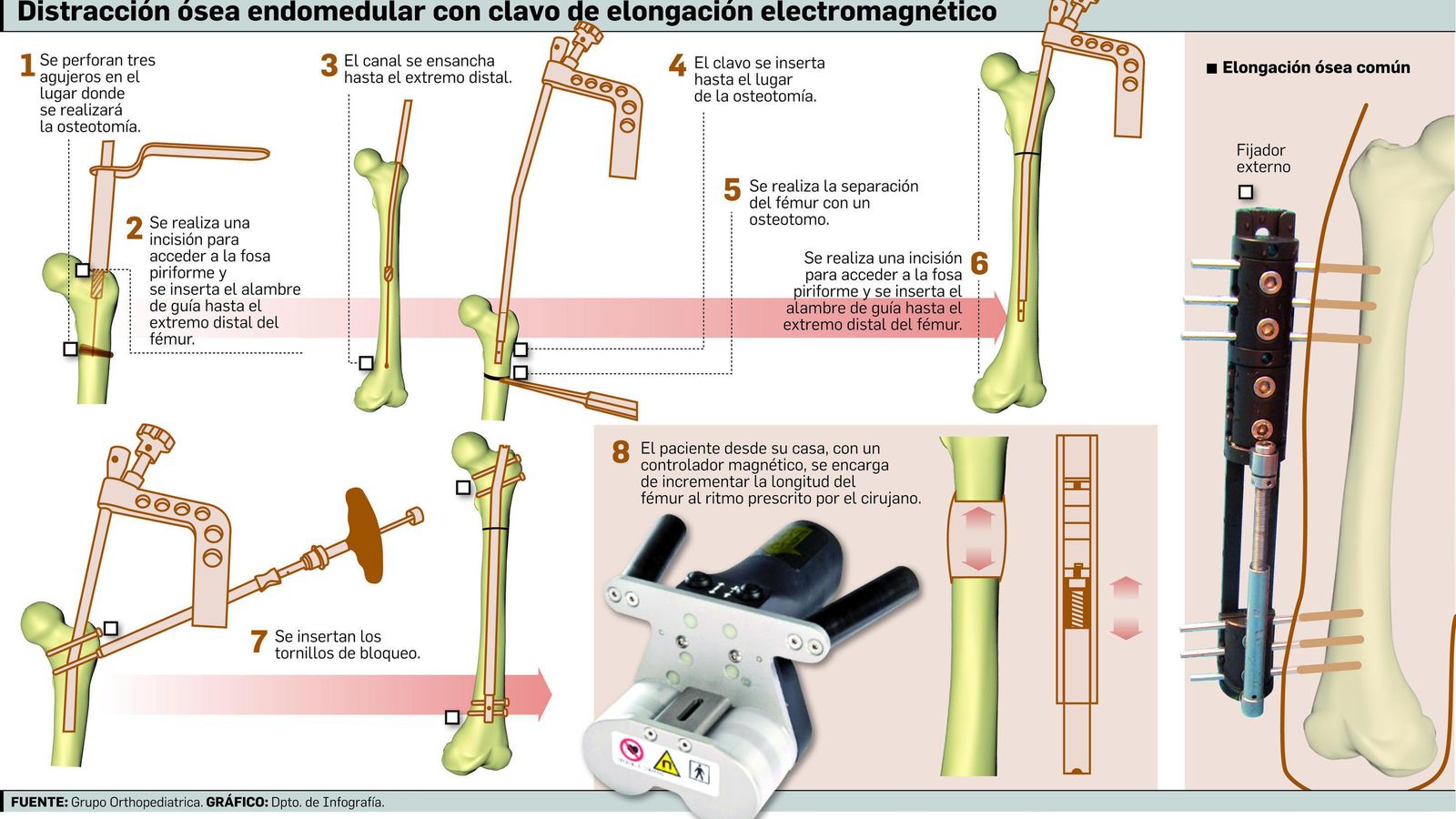 Distracción ósea endomedular con clavo de elogación electromagnético.