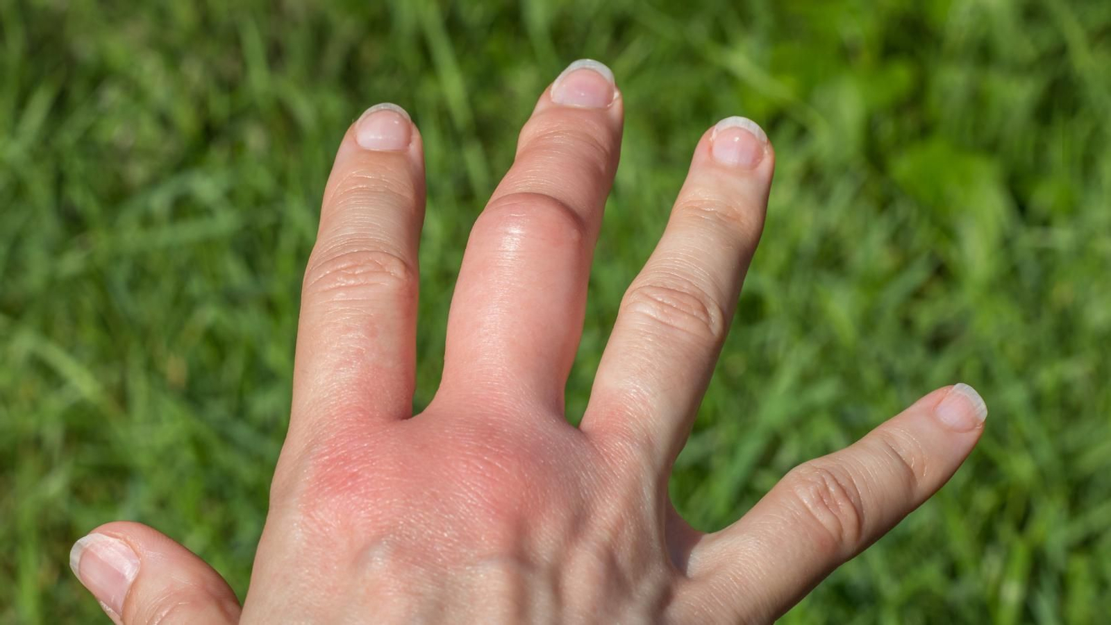 Síndrome de Skeeter: la severa reacción a las picaduras de mosquito que se confunde con otras dolencias