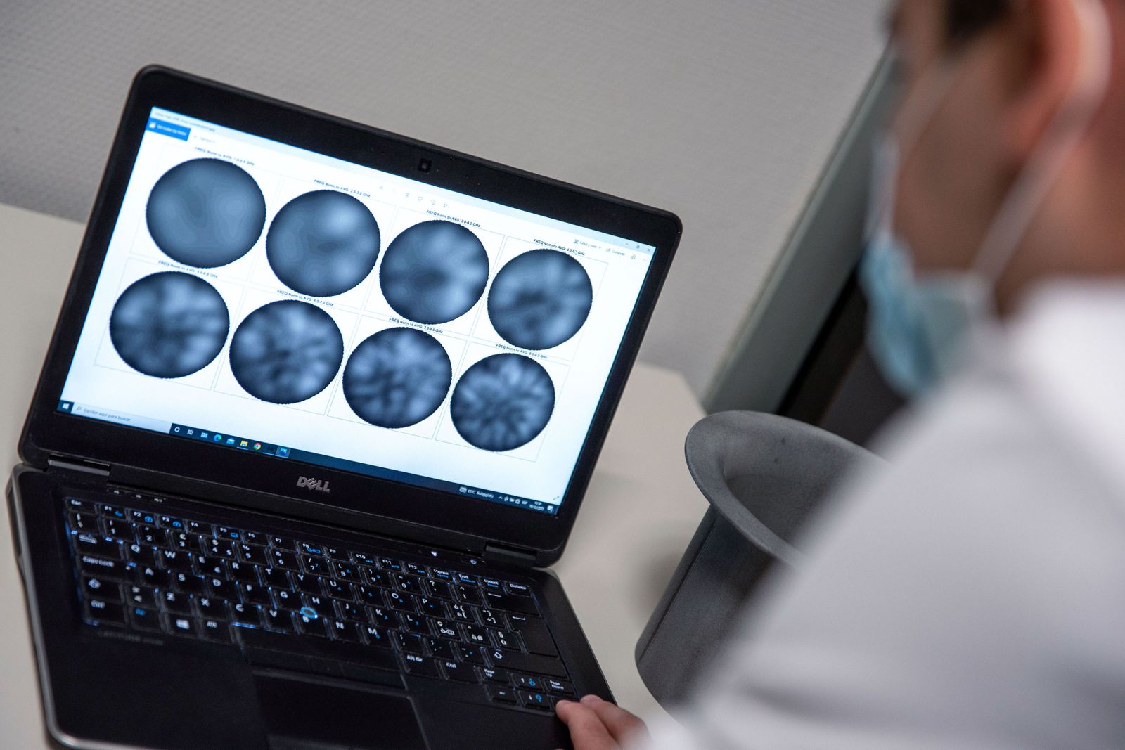 Imágenes de cáncer de mama.