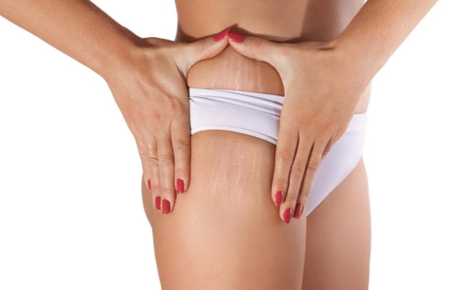 ¿Cómo eliminar las estrías? Causas y tratamiento