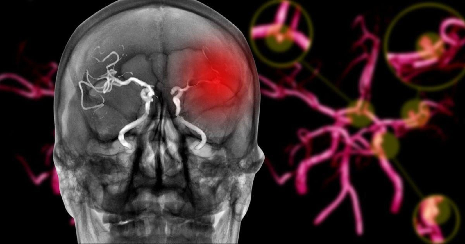 Aneurisma cerebral: estos son los síntomas que nos ponen en alerta