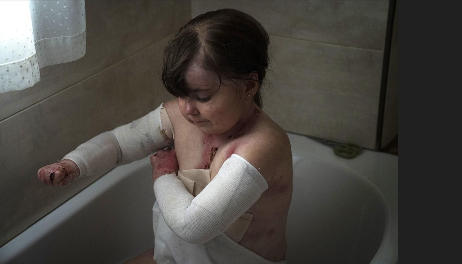 Elena, afectada por la enfermedad de Piel de Mariposa