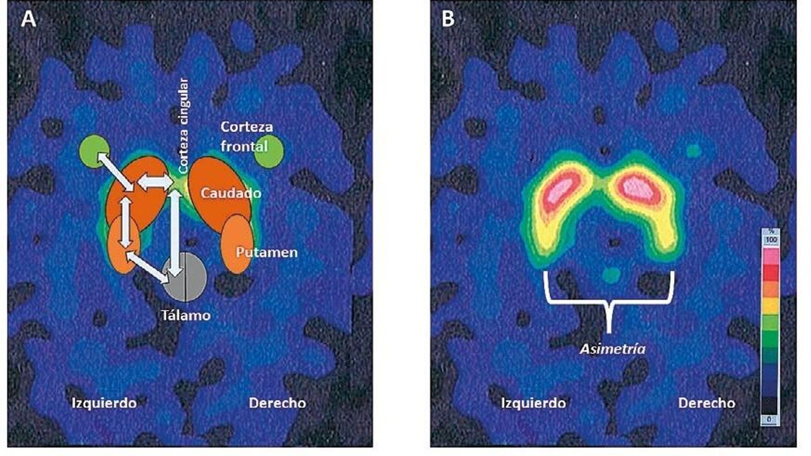 Imágenes DAT-SPECT de un cerebro con enfermedad de Parkinson donde se observa (A) el dibujo de la estructura de la red neuronal cortico-estriado-talámica y (B) la asimetría de la señal dopaminérgica entre los dos hemisferios.
