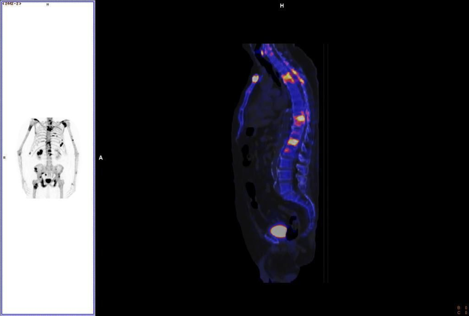 Reconstrucción de gammagrafía ósea.