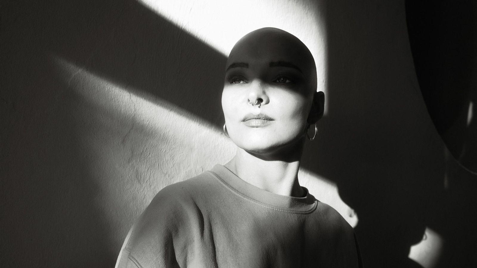 Una mujer con alopecia areata.