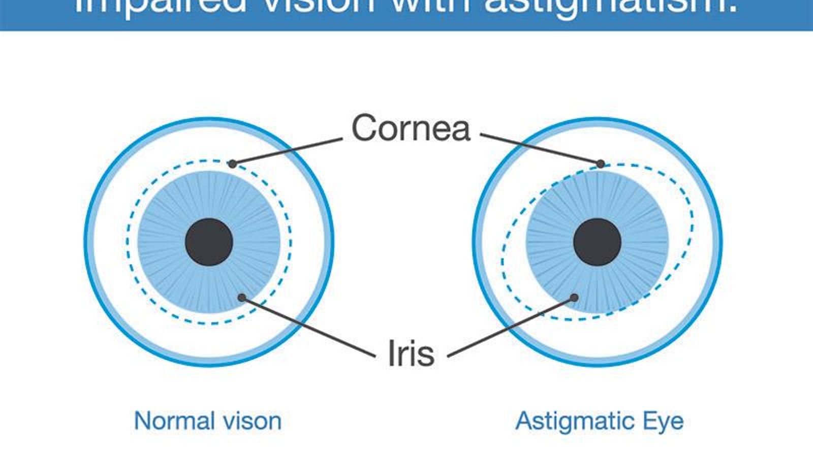 ojo-normal-ojo-astigmatismo