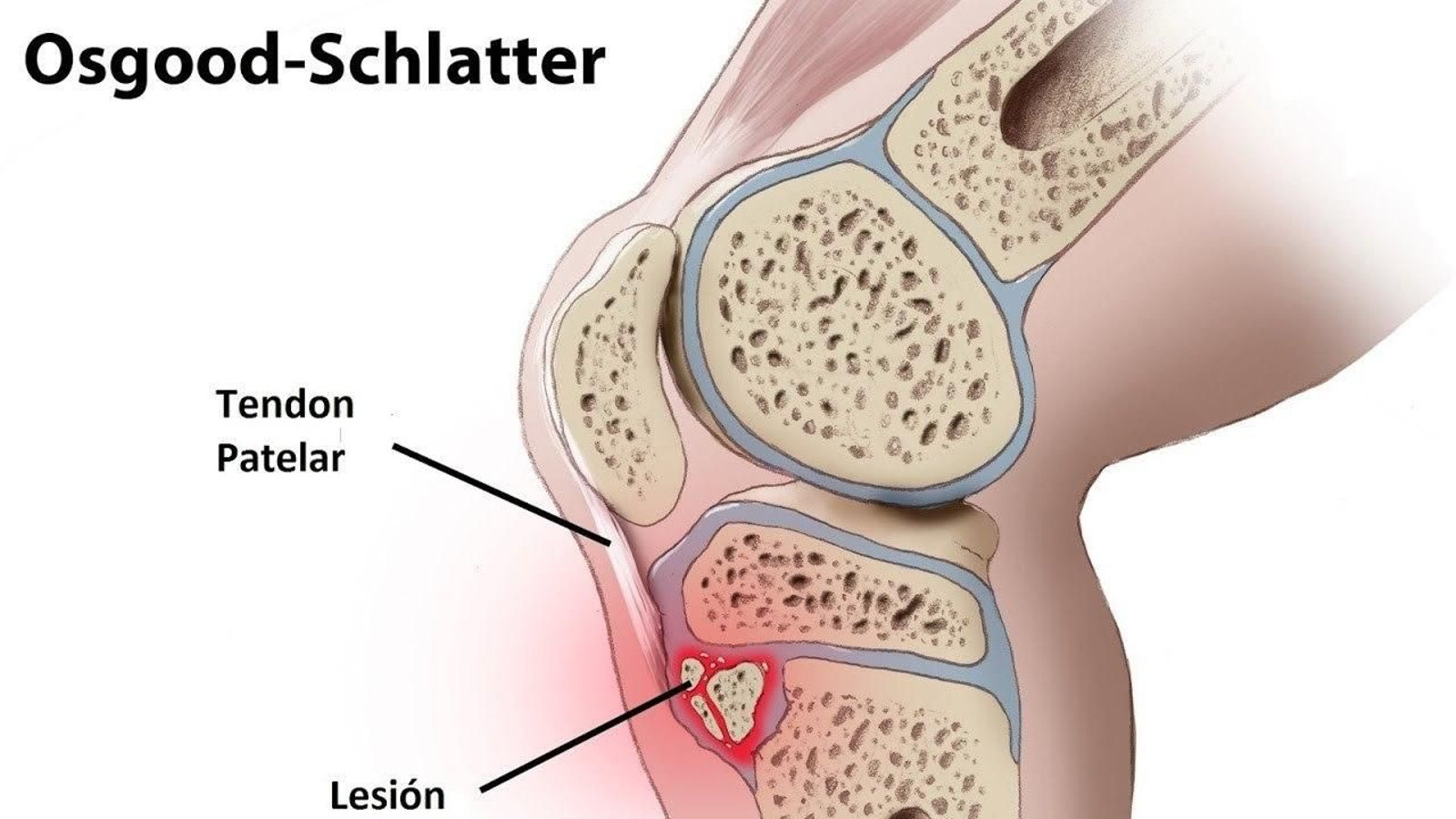 La lesión impronunciable