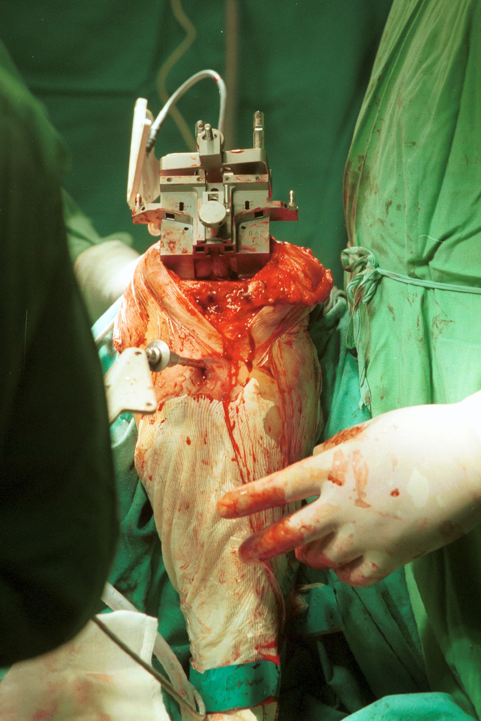 La primera inserción de prótesis de rodilla en Andalucía por infrarrojos data de 2001.