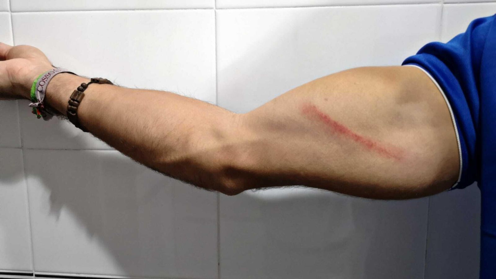 Miguel recibió un pisotón en su brazo derecho en el área pequeña en el segundo gol visitante.