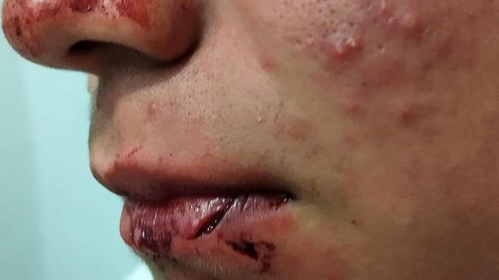 Heridas en rostro y labios del menor agredido