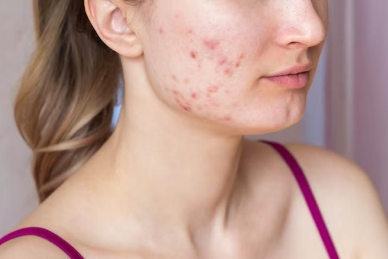 Espironolactona: descubre el fármaco sin antibiótico que acabará para siempre con el acné persistente