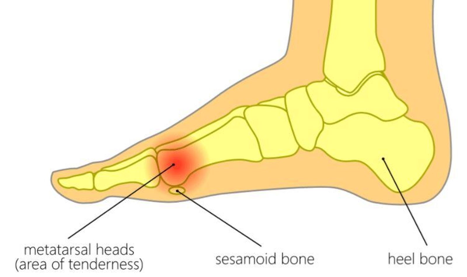 Esquema del juanete.