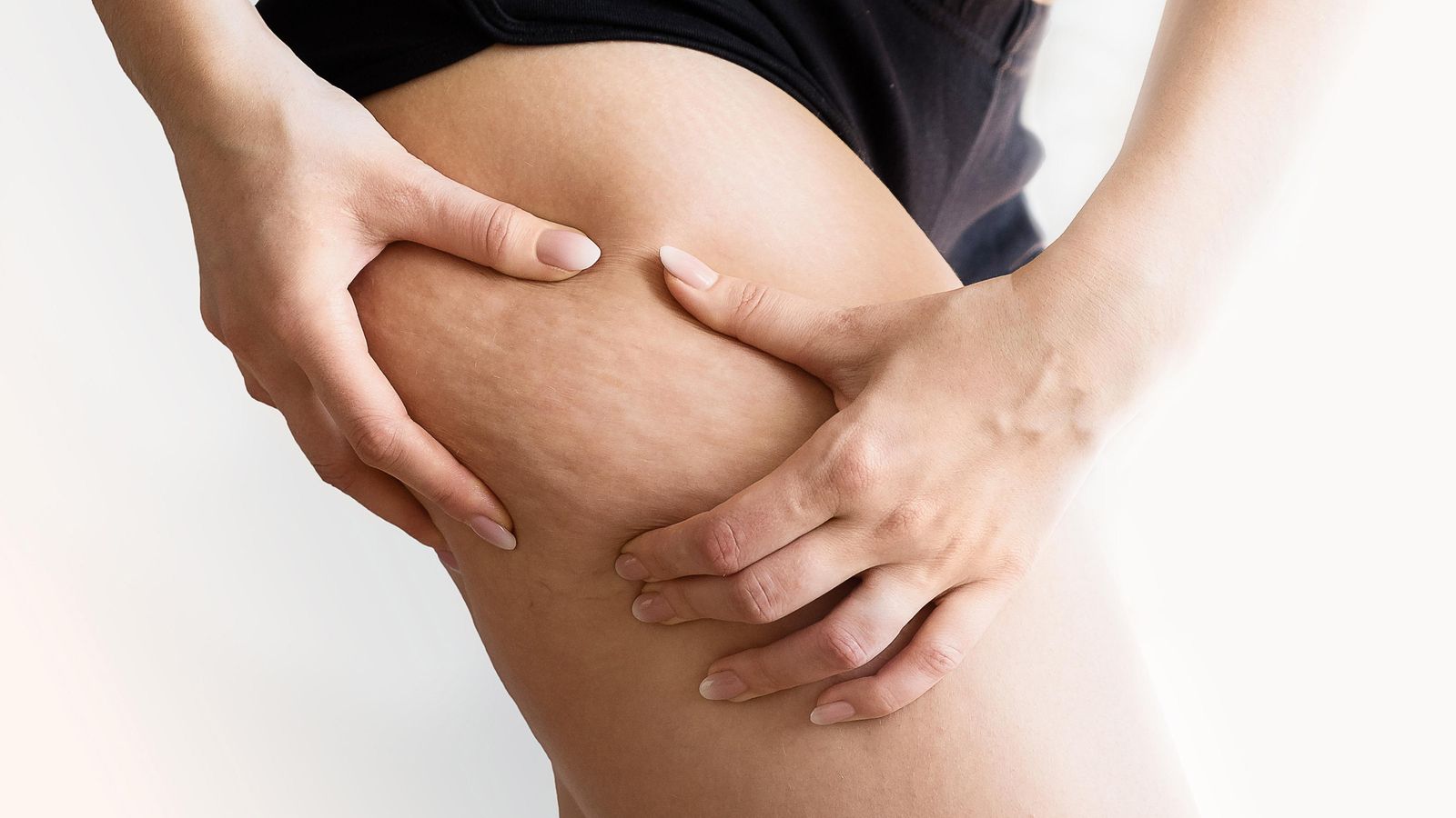 La celulitis es tejido adiposo que se acumula debajo de la piel.