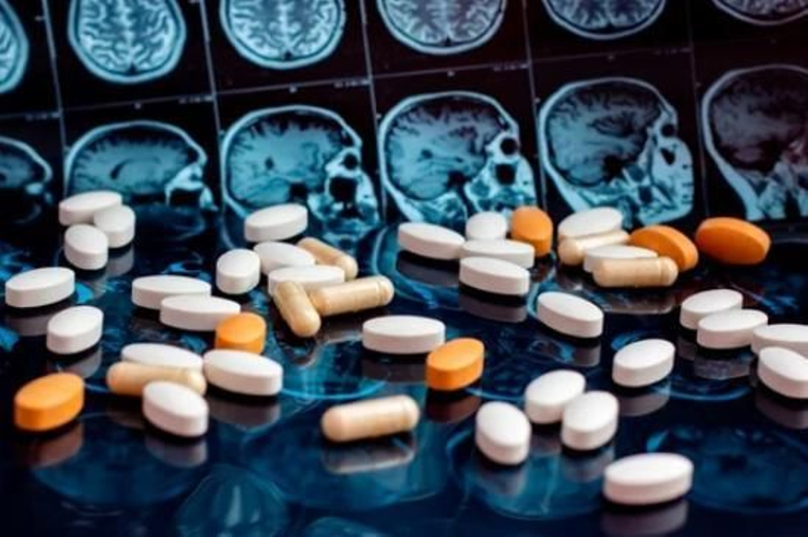 Donanemab, el segundo fármaco esperanzador contra el alzhéimer muestra resultados similares a Lecanemab