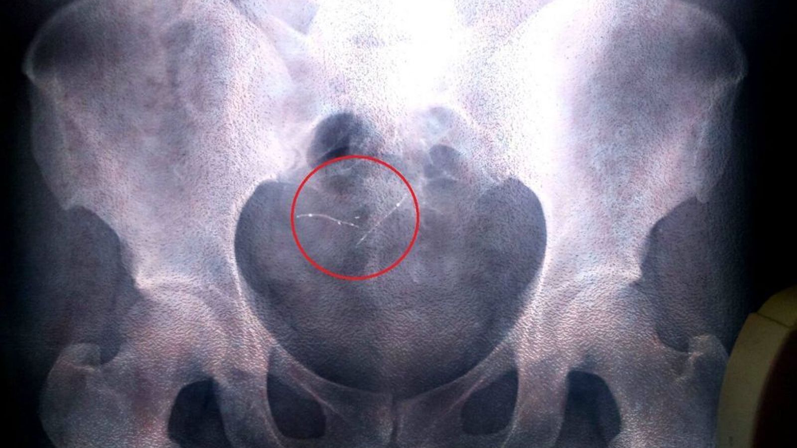 Radiografía en la que se aprecian los muelles desplazados.