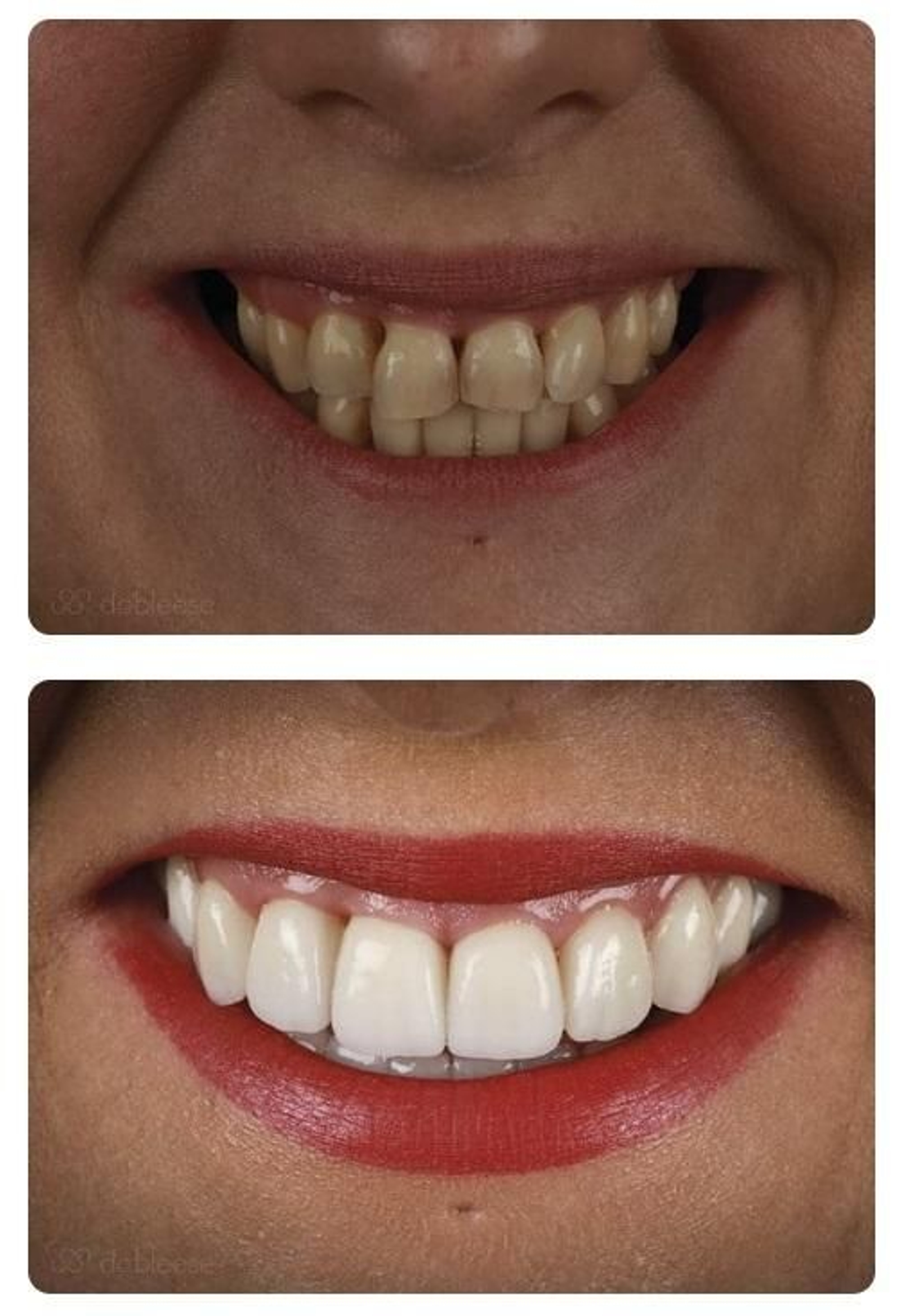 Antes después Dobleese implantes