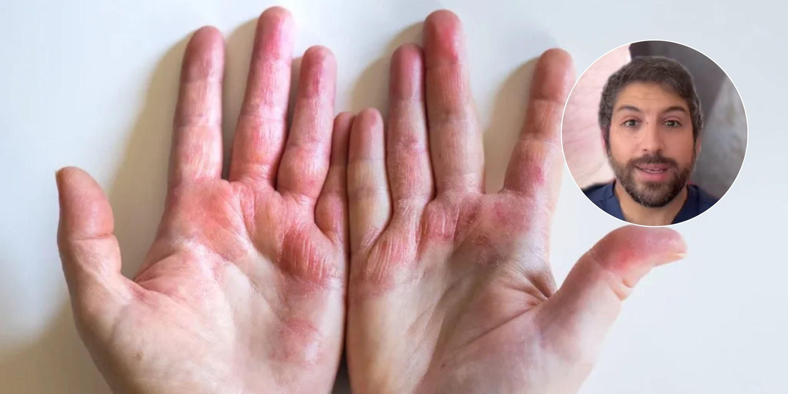 No existe una causa ni una cura clara para la dermatitis dishidrótica.