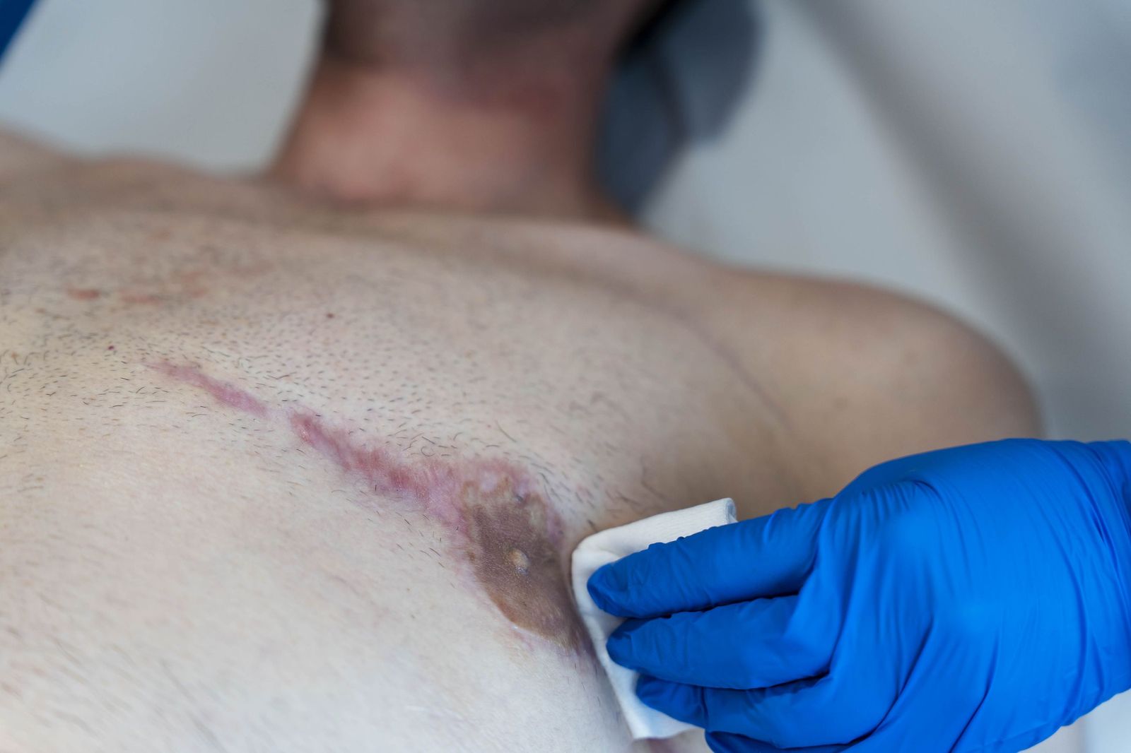 Un tratamiento de micropigmentación por mastectomía en un hombre, en imágenes