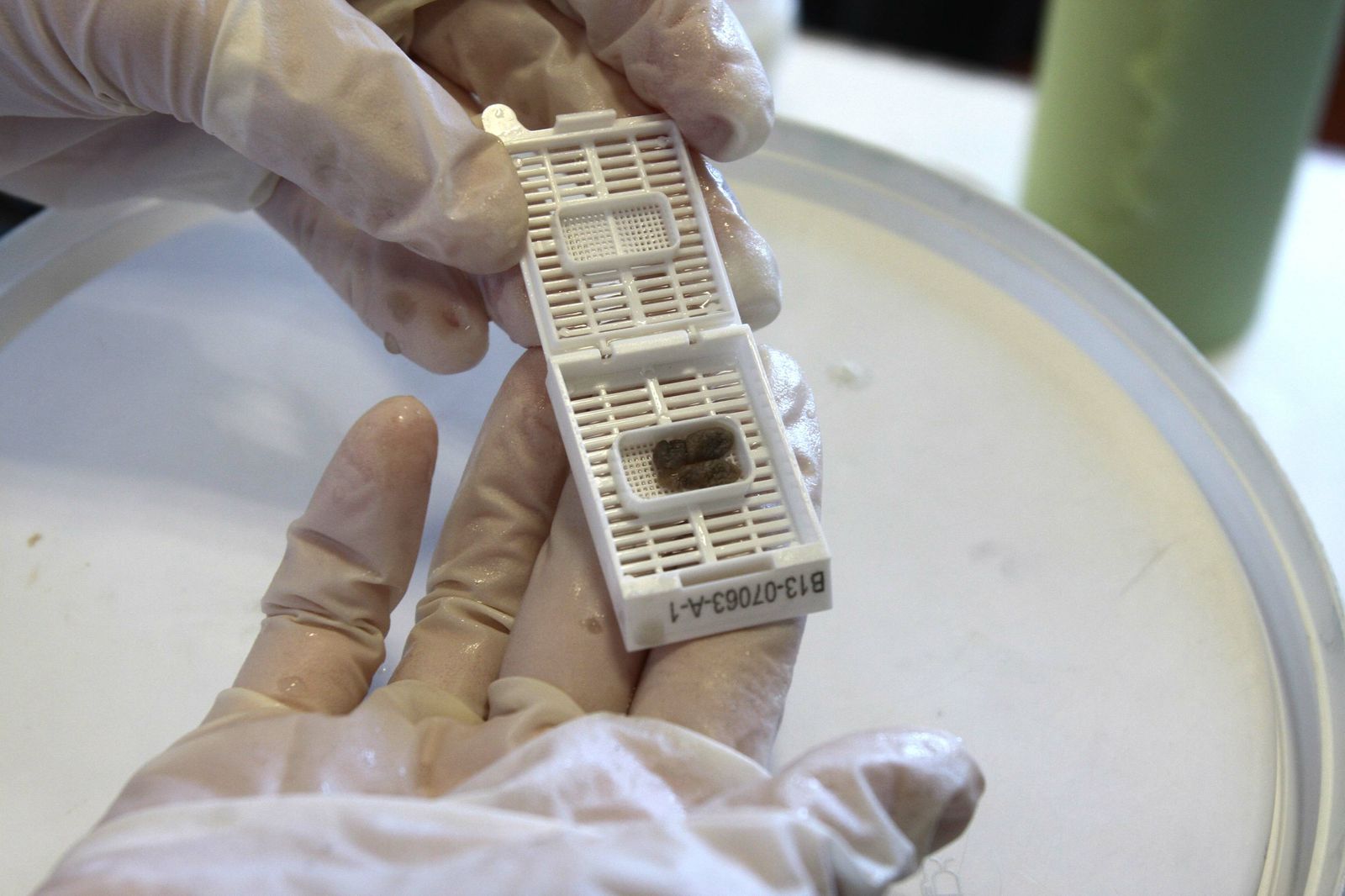 Una muestra de anatomía patológica,  que estudia, por medio de técnicas morfológicas y biomoleculares, las alteraciones que aparecen en los órganos, tejidos y células.