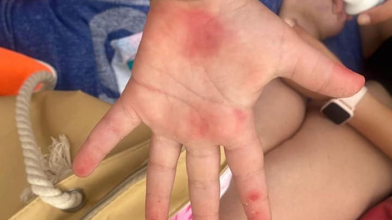 Heridas de los niños.