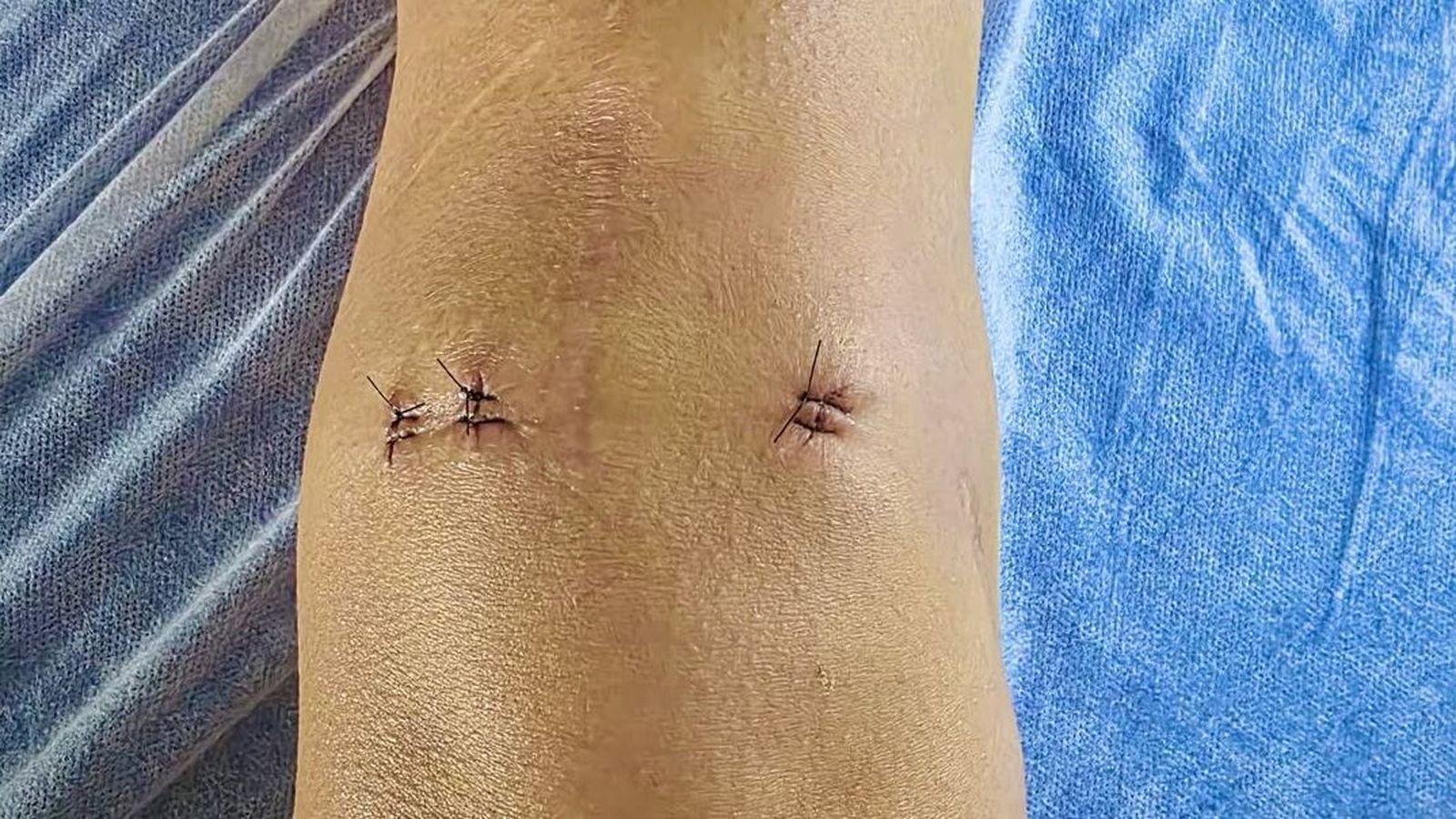 Cicatrices en la rodilla derecha de Carolina Marín.