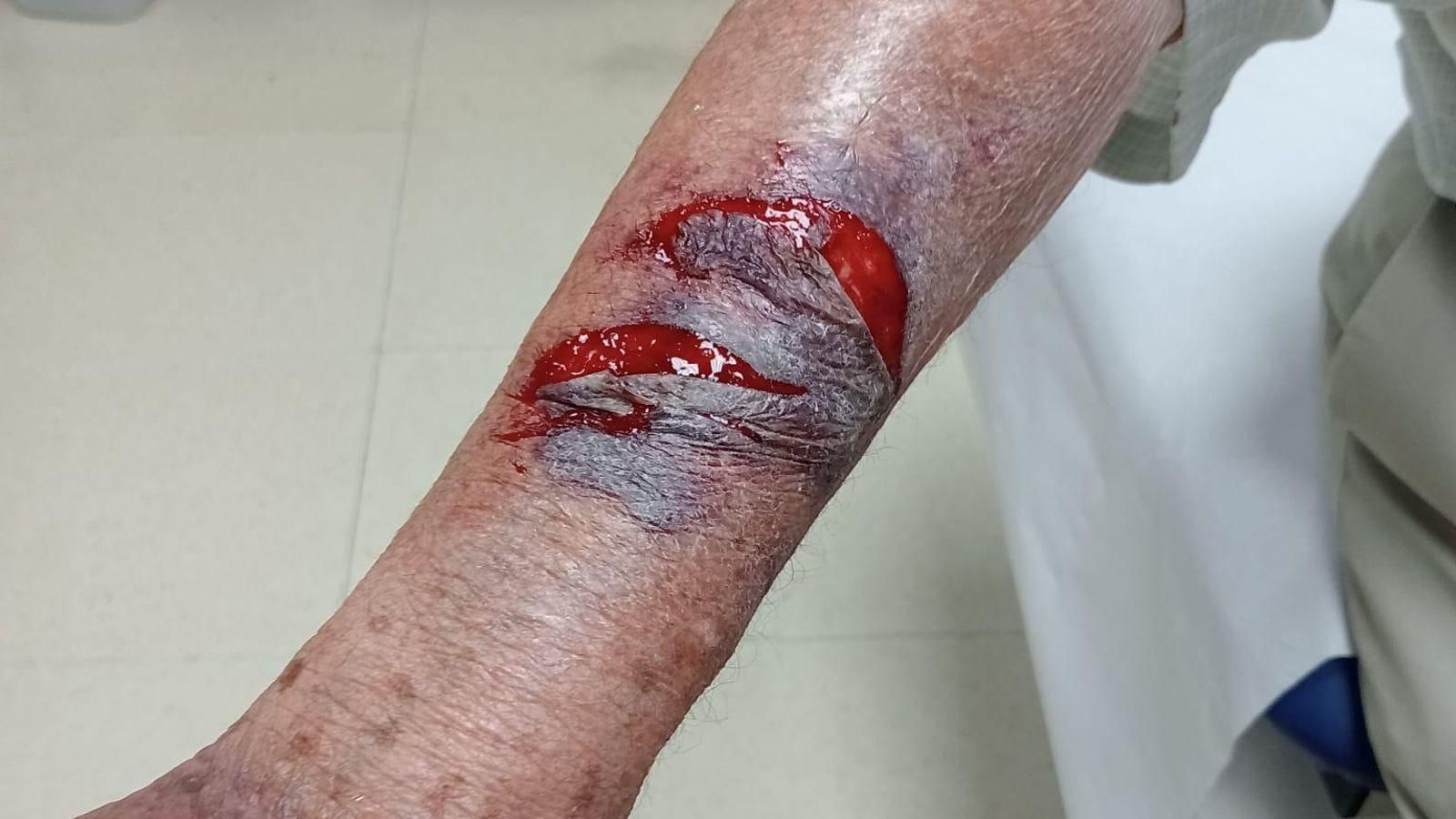 Heridas en uno de los brazos