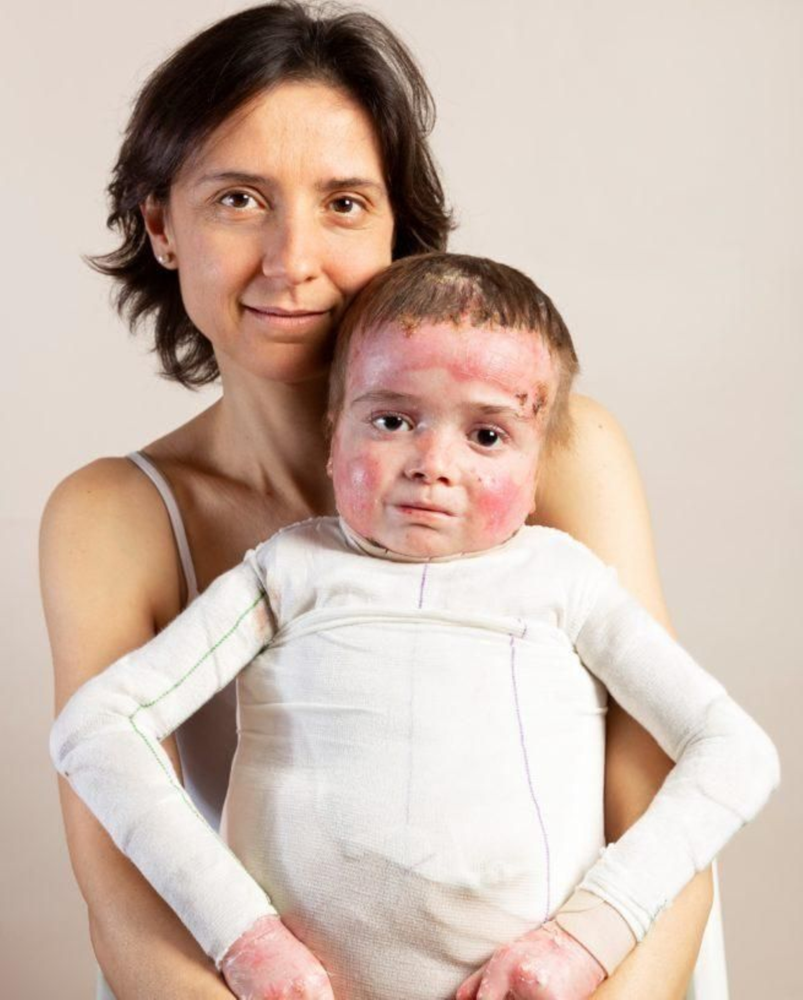 Curan por primera vez las heridas en la piel de ''niños mariposa'' a través de una terapia génica