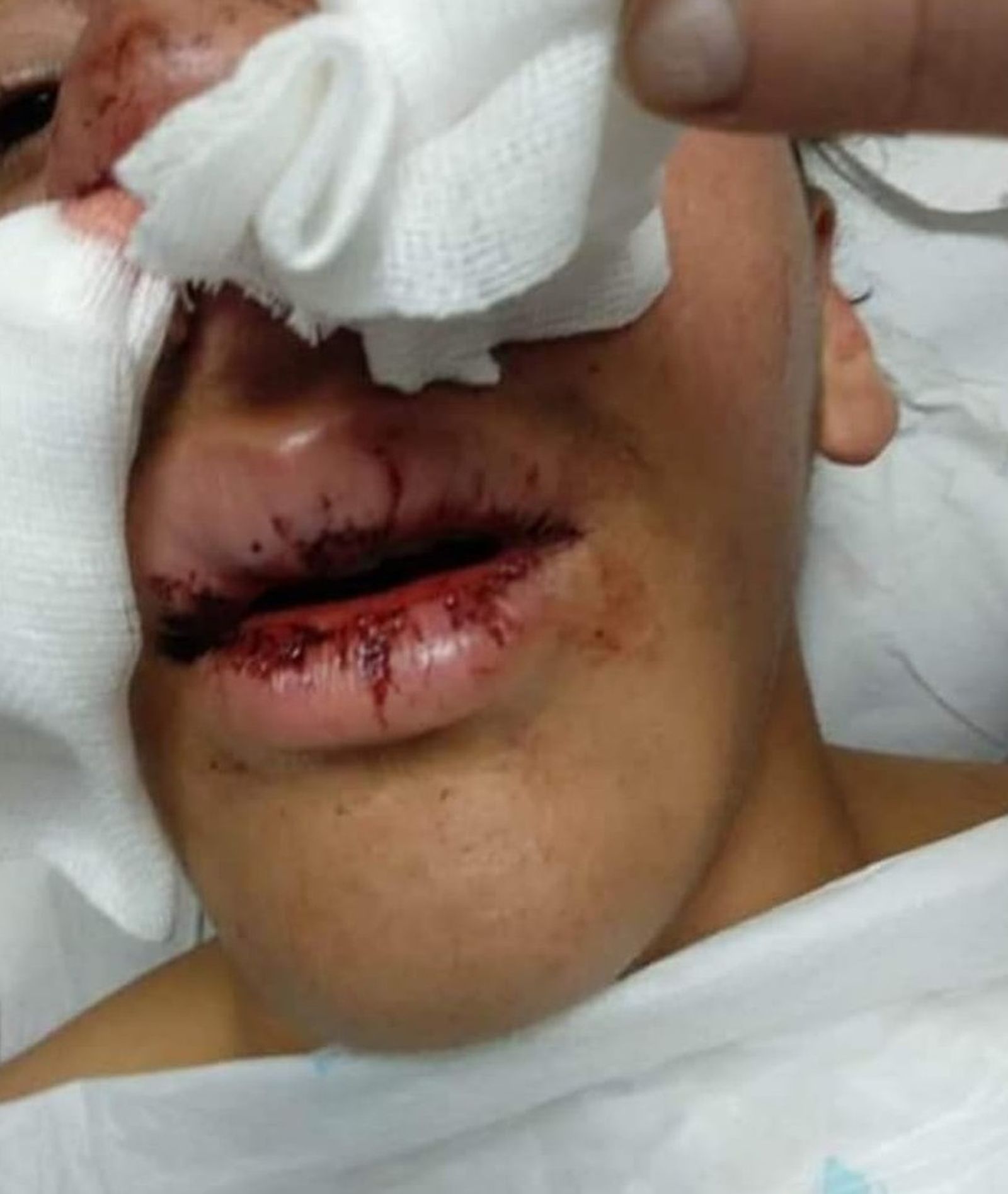 Estado del menor tras la paliza de unos policías en Melilla